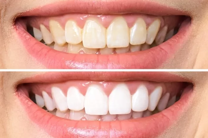 سفید کردن دندانها