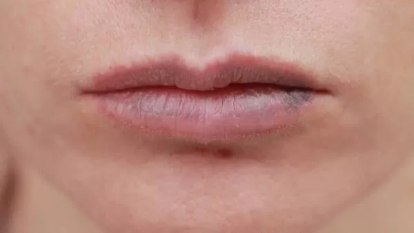 رفع کبودی لب بعد از بوسه