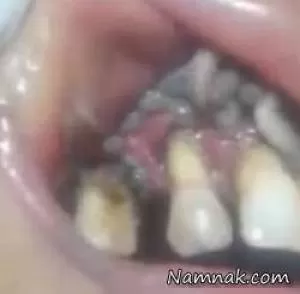 دهان پر از کرم دندان زنده چندش آور یک زن! + فیلم 18+