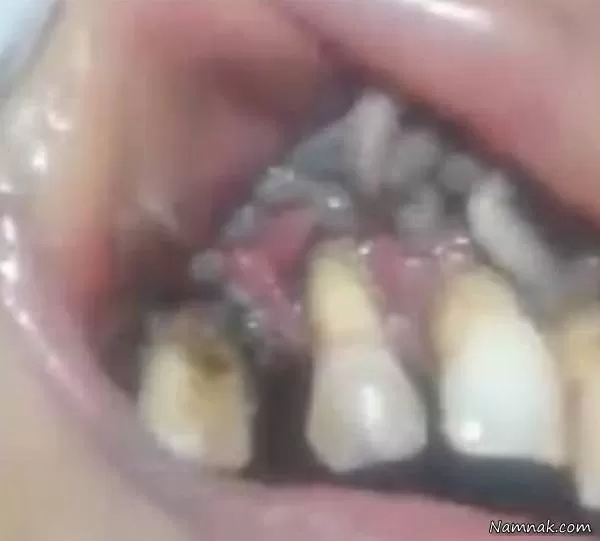 کرم دندان 