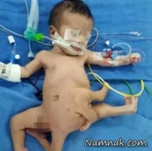 نوزاد عجیب الخلقه با 8 دست و پا جراحی شد