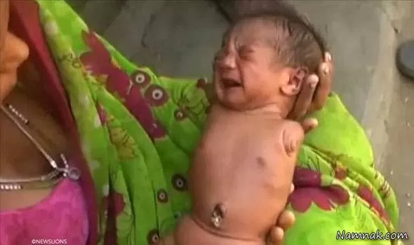 نوزاد بدون دست