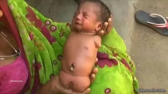نوزاد بدون دست و پا