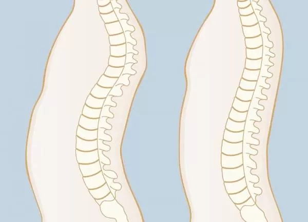 درمان قوز پشت