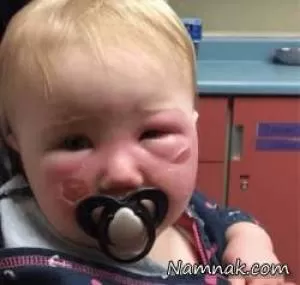 سوختگی شدید صورت کودک با کرم ضد آفتاب! + تصاویر