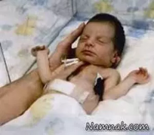 پیوند قلب , نوزادی که با قلب میمون زنده شد +عکس