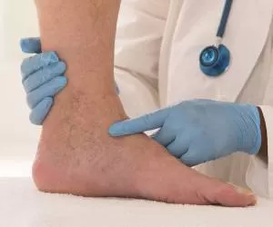لخته شدن خون در پا نشانه چه بیماری است ؟ + علت لخته خون در پا