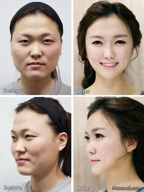 جراحی زیبایی دختر چینی