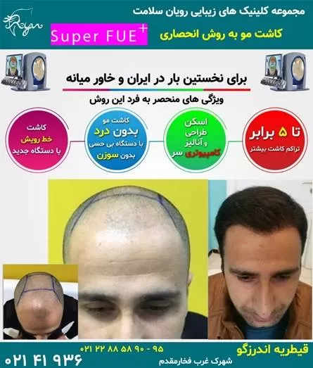 کاشت مو