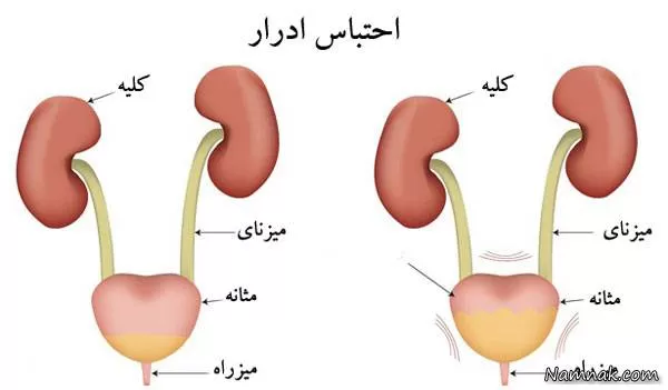 درمان سختی ادرار 