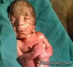تصاویری دردناک از تولد نوزاد مبتلا به سندرم پری دریایی