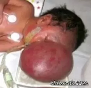 جراحی نوزادی که مغزش بیرون از چشمانش بود+تصاویر