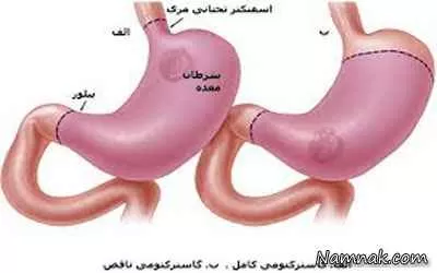 سرطان معده