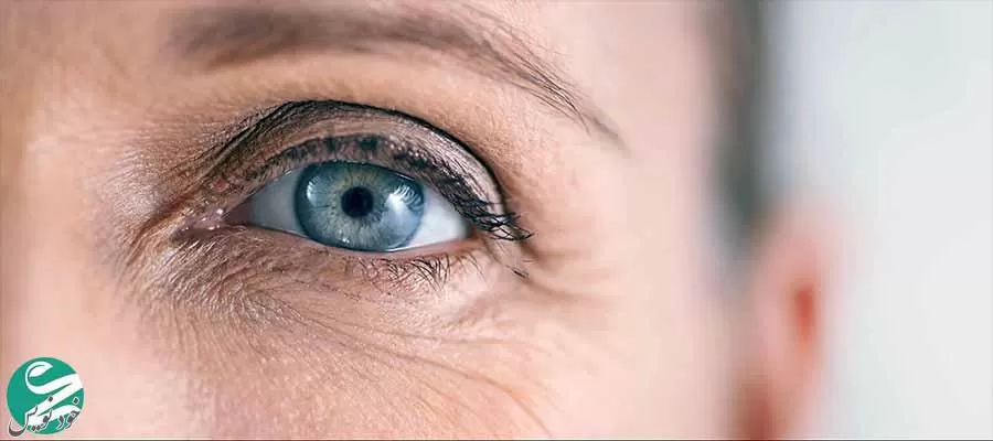 علت لرزش پلک (پرش پلک) چیست و چطور درمان میشود؟ |علل پرش پلک و یا نبض چشم چیست؟
