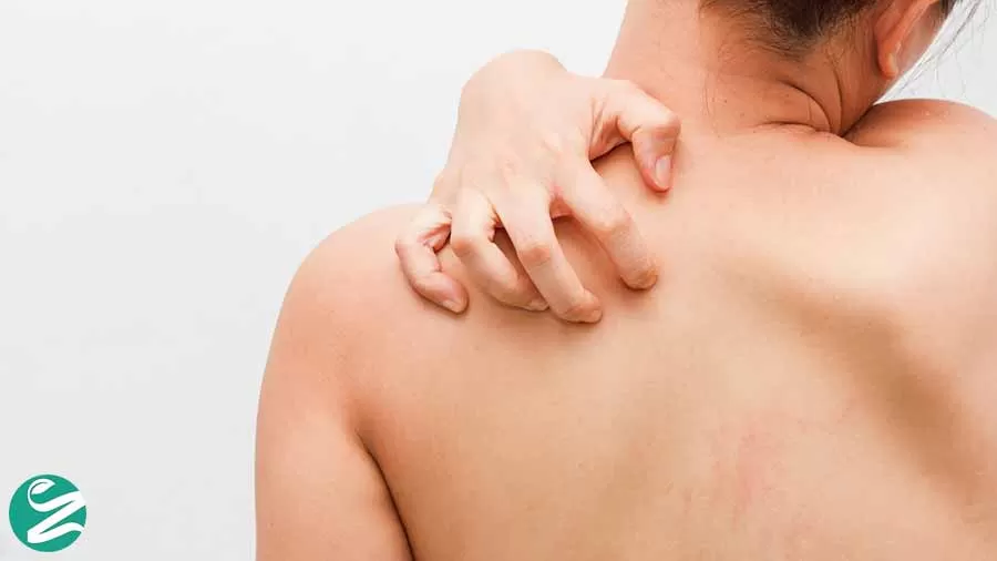 عفونت پوست چیست؟ از تشخیص تا درمان انواع عفونت های پوستی