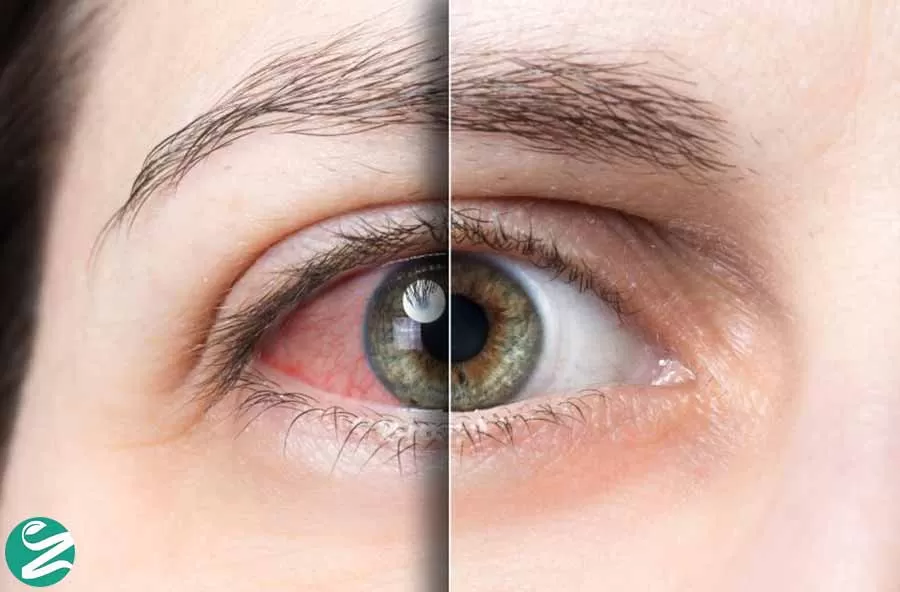 علت خشکی چشم چیست؟ دلایل و درمان